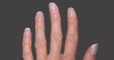 ألوان الأظافر تكشف أسرار صحتك.. متى تزور الطبيب؟